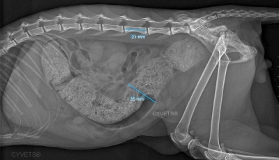 Megacolon- Subtotal colectomy