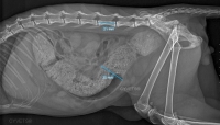 Megacolon- Subtotal colectomy